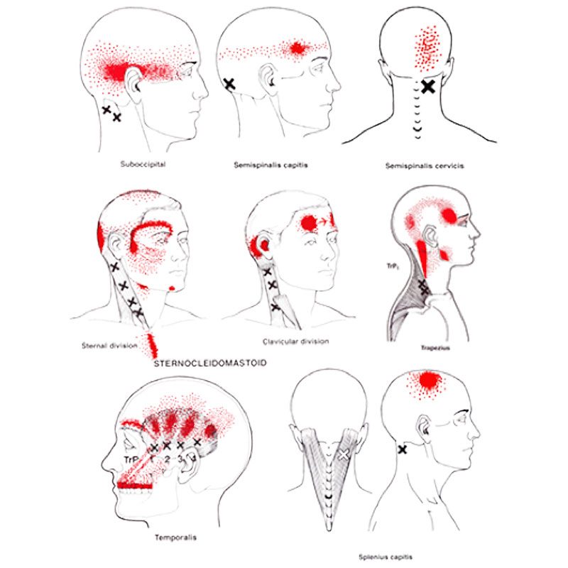 Massage For Migraine Headaches Pain Book Online Now