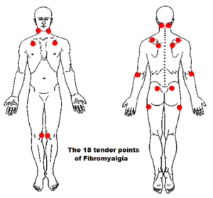 fibromyalgia natural treatment -tender points