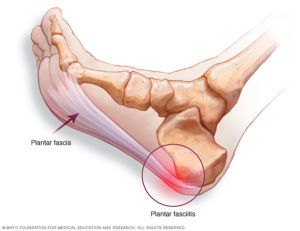 Reflexology for Plantar Fasciitis - picture of foot