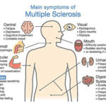 multiple_sclerosis_symptoms